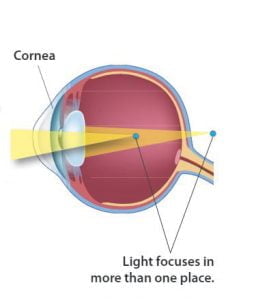 refrakciós hiba myopia hyperopia astigmatizmus