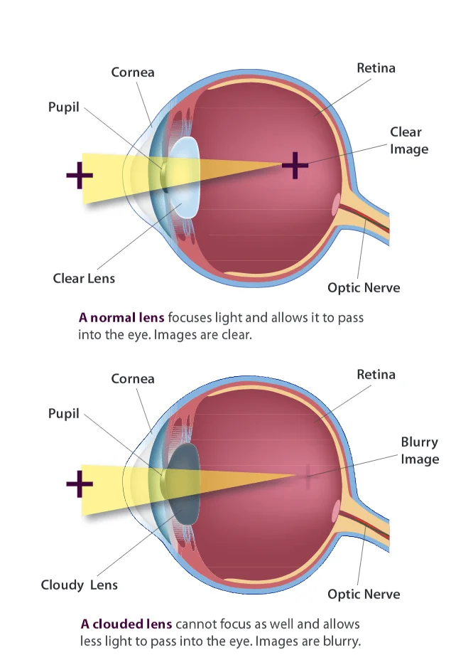 illustration of an eye cross section showing a clear lens and a cloudy lens