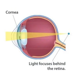 presbyopia eye diagram 