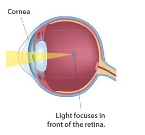 myopia eye diagram , myopia vs hyperopia