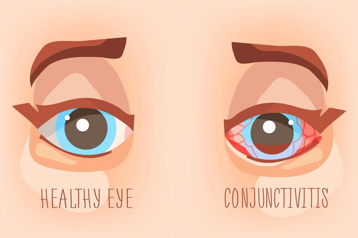 What is Pink Eye? | Signs and Symptoms