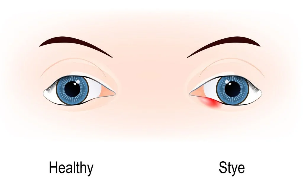 How To Get Rid of a Swollen Eyelid | Causes and Treatment